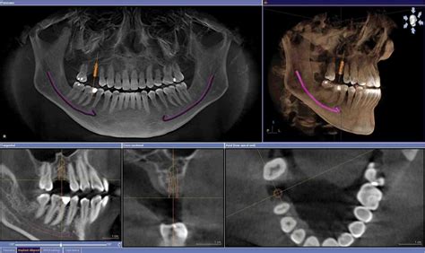 Can you have a ct scan with dental implants - Dental News Network