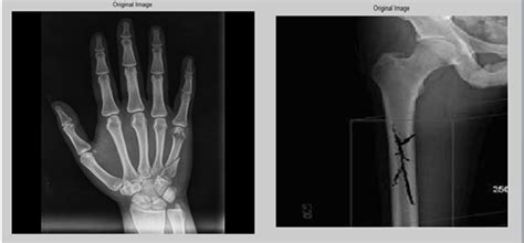 The original images of right hand and hairline bone fracture | Download ...