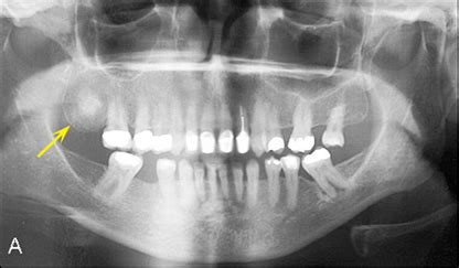 Maxillary Tuberosity Radiograph