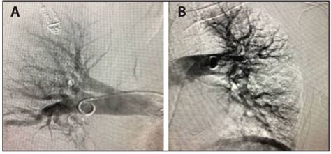 Improving the Risk/Benefit Profile for Managing VTE With Lytic-Free ...