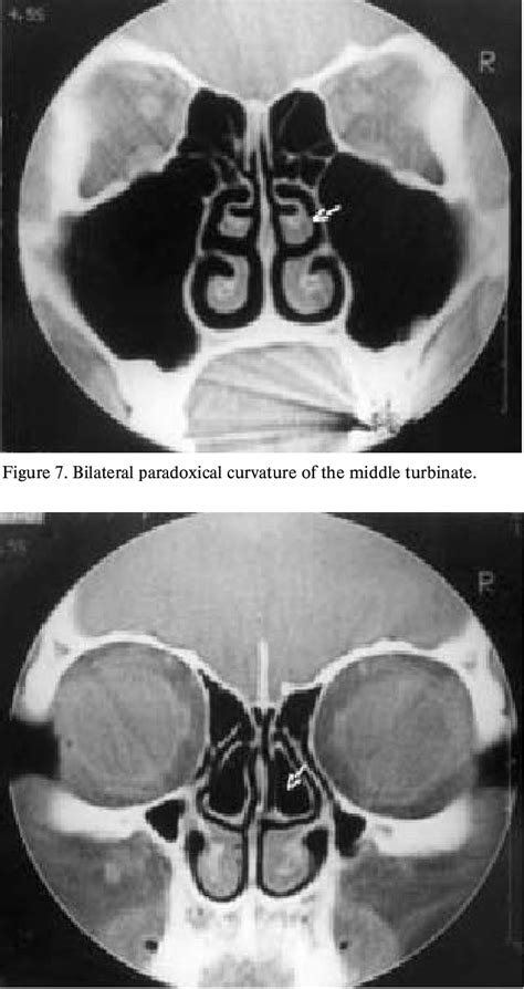 Bilateral concha bullosa. | Download Scientific Diagram