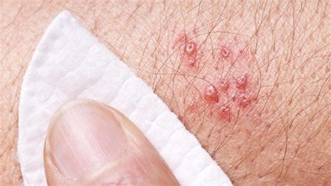 Approximately 1 in 3 individuals will experience shingles during their lifetime.