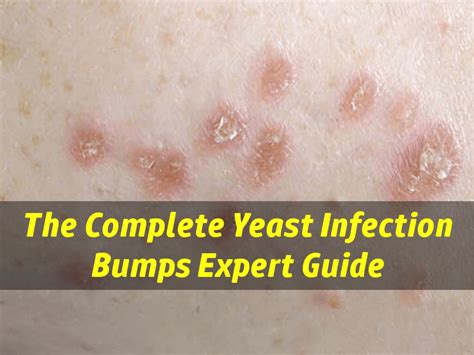 Yeast Infection Bumps - Are Your Skin Bumps Caused By Yeast Infection?