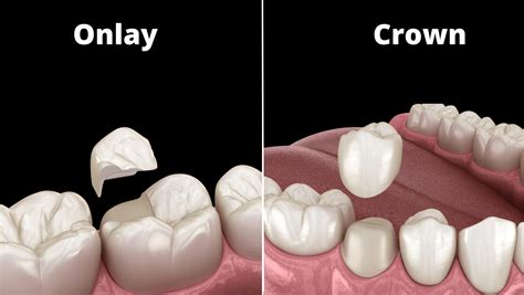 What’s the Difference between Onlay and Crown