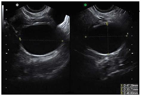 The characteristic ultrasound features of specific types of ovarian pathology (Review)