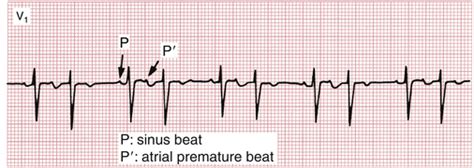 Supraventricular Arrhythmias, Part I: Premature Beats and Paroxysmal Supraventricular ...