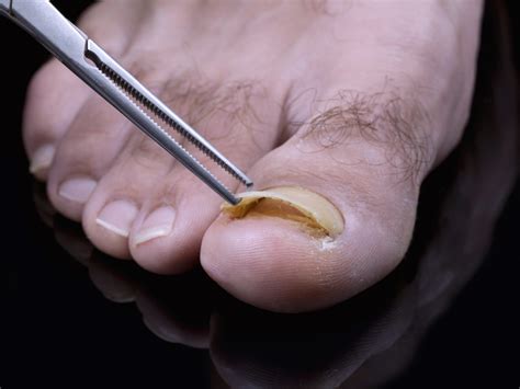 Toenail fungus treatment - Atlanta Podiatrists: Atlanta Foot and Ankle ...