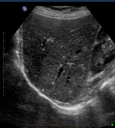 Starry sky appearance (ultrasound) | Radiology Reference Article | Radiopaedia.org