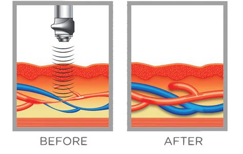 Acoustic Wave Therapy - Prime Medical Solutions of Sarasota