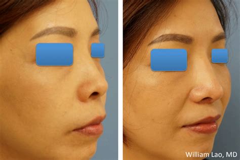 Asian Rhinoplasty New York City | Ethnic Rhinoplasty Manhattan