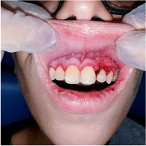 Gingivostomatitis Vs Herpes Labialis