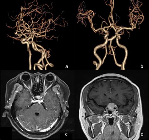 Image of a patient with aneurysm clipping during surgery. (a, b) Left... | Download Scientific ...