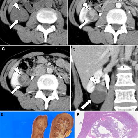 A 75-year-old male with pT1 papillary RCC (type 2). The tumor was... | Download Scientific Diagram