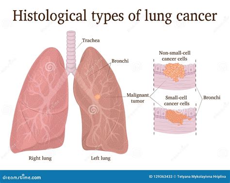 Illustration of Lung Cancer Types Stock Vector - Illustration of breath ...