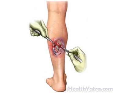 Best Cost Debridement of a Wound, Infection, or Burn Surgery, Treatment ...