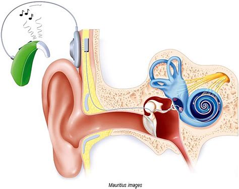 Frontiers | Cochlear implant-specific risks should be considered, when assessing the quality of ...