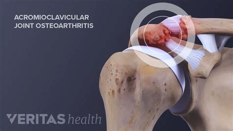 Acromioclavicular Joint Arthritis Treatment - Quotes Resume