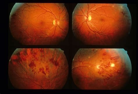 Eales Disease - Retina Image Bank