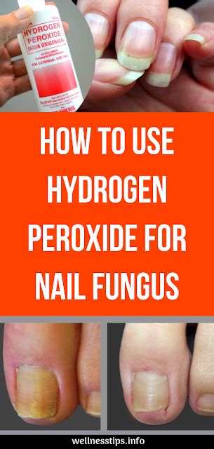 Hydrogen Peroxide Toenail Fungus Before And After - lvandcola