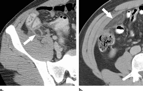 Acute epiploic appendagitis near the cecum. Axial contrast-enhanced CT ...