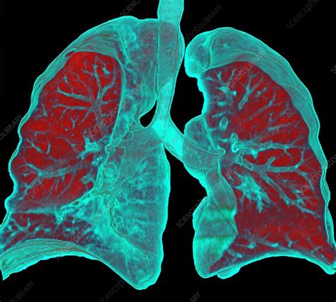 Normal lungs, CT scan - Stock Image - C016/6691 - Science Photo Library