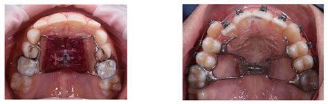 Hyrax Appliance Rapid Maxillary Expansion