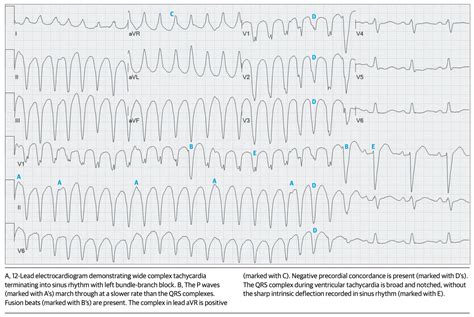 ECG Diagnosis of Wide Complex Tachycardia - JournalFeed