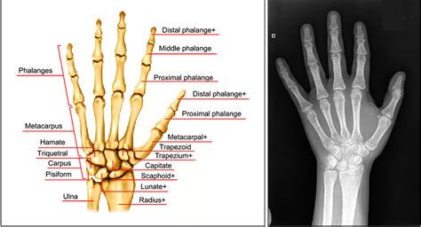 Skeletal anatomy [4] and an X-ray image of a hand [5]. | Download Scientific Diagram