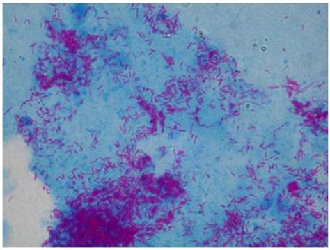 Ziehl-Neelsen acid-fast staining procedure | Medical Laboratories