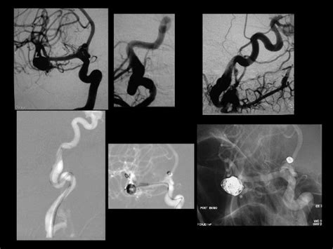 Clipping or Coiling for MCA Aneurysm