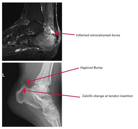 Tendinosis Mri | My XXX Hot Girl