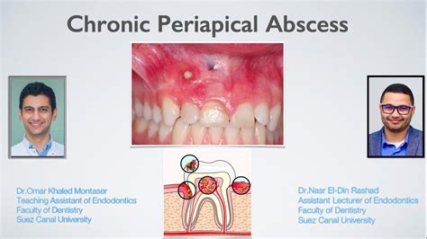 Chronic Periapical Abscess