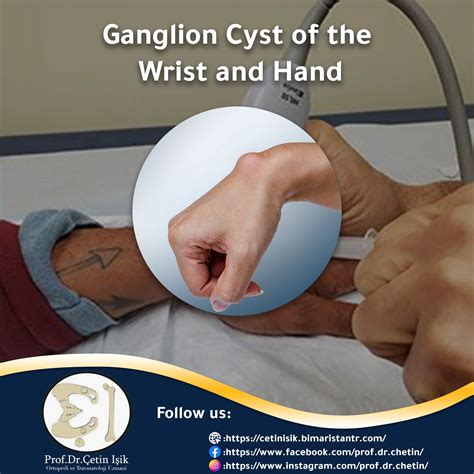 Ganglion cyst in the hand, symptoms and treatment - Dr. What's wrong with you?