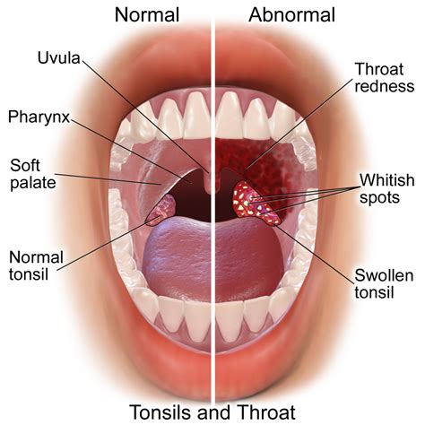 Tonsillitis | ENT Buffalo NY | Dr. Paul R. Young, MD