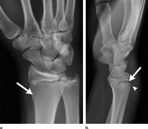 Salter-Harris type II fracture in a 15-year-old boy. (a) Slightly... | Download Scientific Diagram