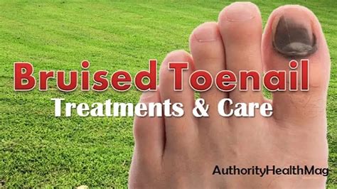 Bruised Toenail: Best Way To Treat Toenail Trauma