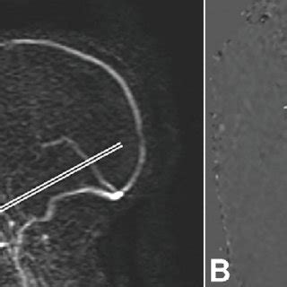 Phase Contrast MRI. Sagittal 2D phase contrast image (A) to illustrate... | Download Scientific ...