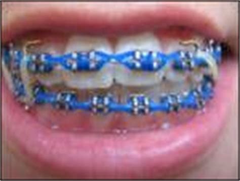 231 best braces color ideas images on Pinterest | Braces colors, Brace face and Braces