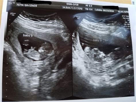 8 Week Ultrasound Pictures Twins