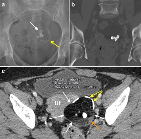 Ovarian dermoid cyst - Radiology at St. Vincent's University Hospital