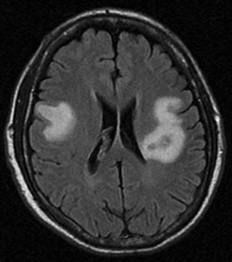 Brain abscess causes, signs, symptoms, diagnosis, treatment & complications