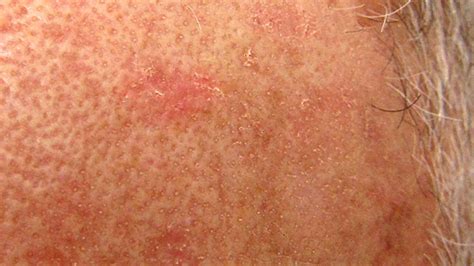 Discolored Skin Patches: Pictures, Causes, and Treatments