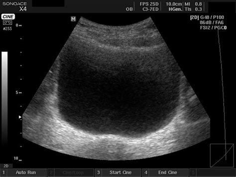 Ultrasound images • Bladder, B-mode, echogramm №400