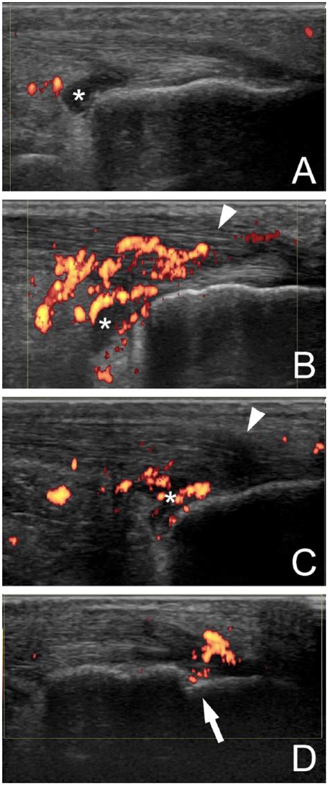 Representative ultrasound (US) images of the Achilles tendon (AT ...