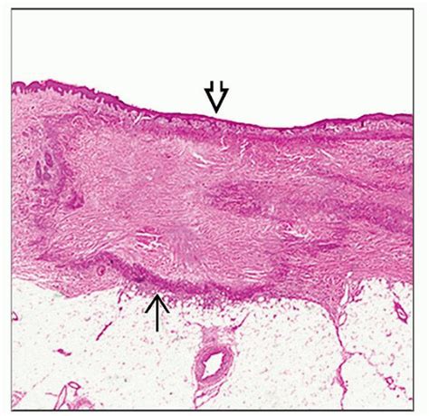 Epithelioid Sarcoma | Basicmedical Key