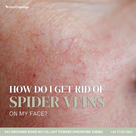 How do I get rid of spider veins on my face? - Healthsprings