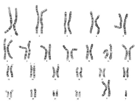 Klinefelter Syndrome - UVM Genetics & Genomics Wiki