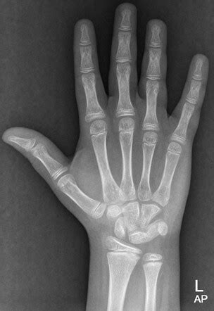 Lunotriquetral coalition | Radiology Case | Radiopaedia.org