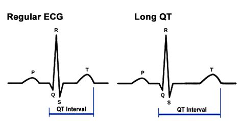 The Different Types of LQTS — Thryv Therapeutics