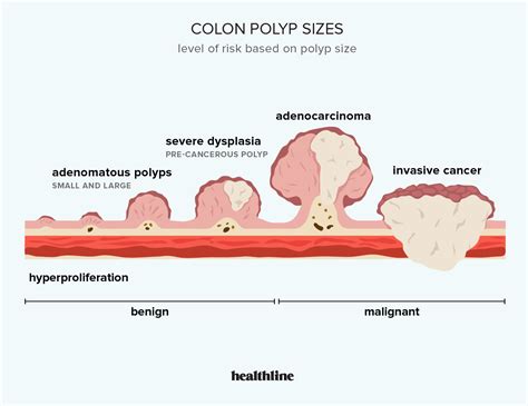 Colon Polyp Size and Type Charts